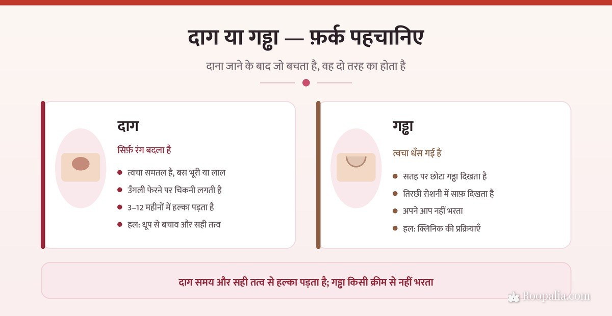 मुँहासों का दाग और गड्ढा में फ़र्क — रंग बदलना बनाम त्वचा का धँस जाना